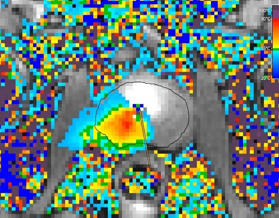 TULSA prostate PS