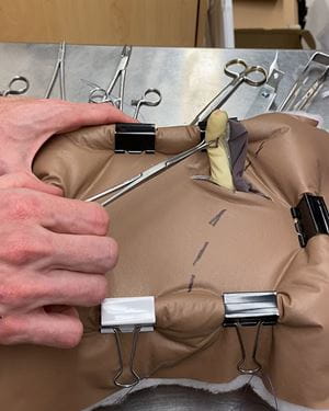 A model of an appendix being delivered through a model of an abdominal wall