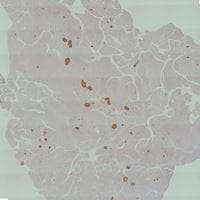 Picture of the paraffin section of pancreas tissue from mouse exposed to cigarette smoke.  Immunostaining analysis revealed that the insulin producing cells (shown as red/brown spots) were dramatically reduced by the cigarette smoke exposure. An image taken from a microscope.