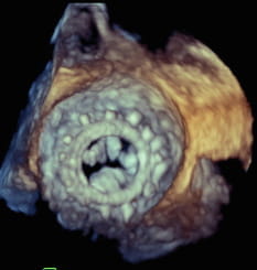 Vascular plug