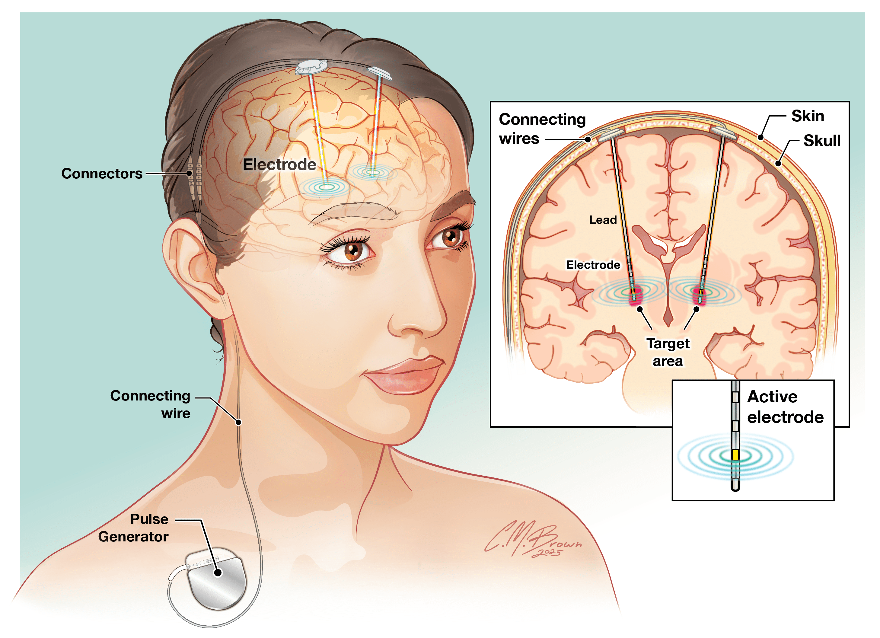 medical illustration showing how deep brain stimulation is given to a patient. a pulse generator sits on the collarbone, with a connecting wire leading to electrodes implanted in the brain.