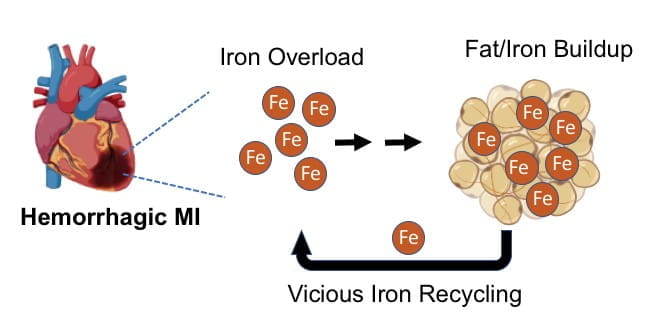 This illustration illustrates the iron overload and fat and iron buildup that occurs in hemorrhagic MI. 