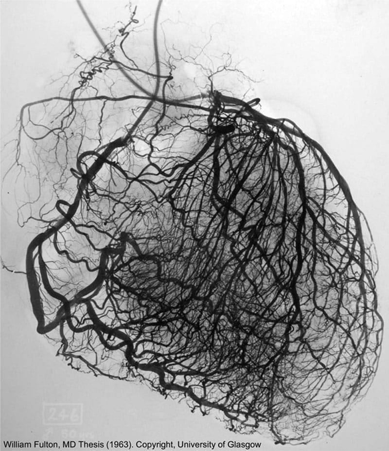 This is a stereoarteriogram of the left and right coronary arteries of heart which shows multiple nonobstructive plaques.