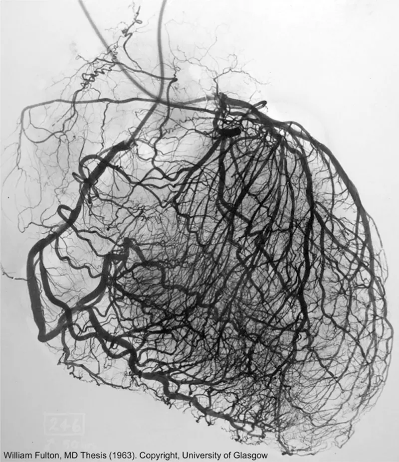 This is a stereoarteriogram of the left and right coronary arteries of heart which shows multiple nonobstructive plaques.