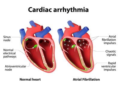Illustration comparing normal heart to one with Atrial Fibrillation.