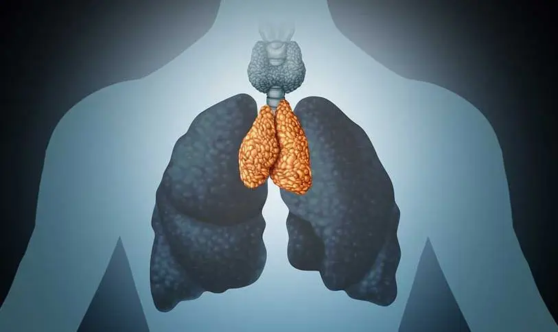 This illustration shows cancer growth in the thymus, a lymphoid organ of the immune system.