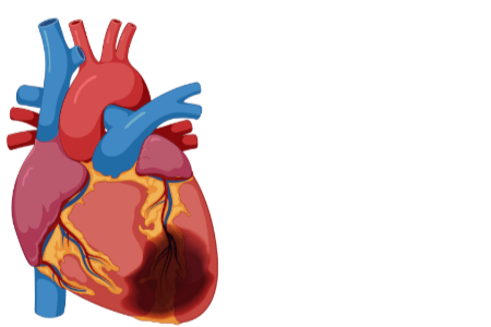 Animated ischemic heart disease icon that illustrates hemorrhage and heart damage in the heart organ.
