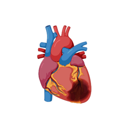 Ischemic heart disease illustrates hemorrhage and heart damage in the heart.