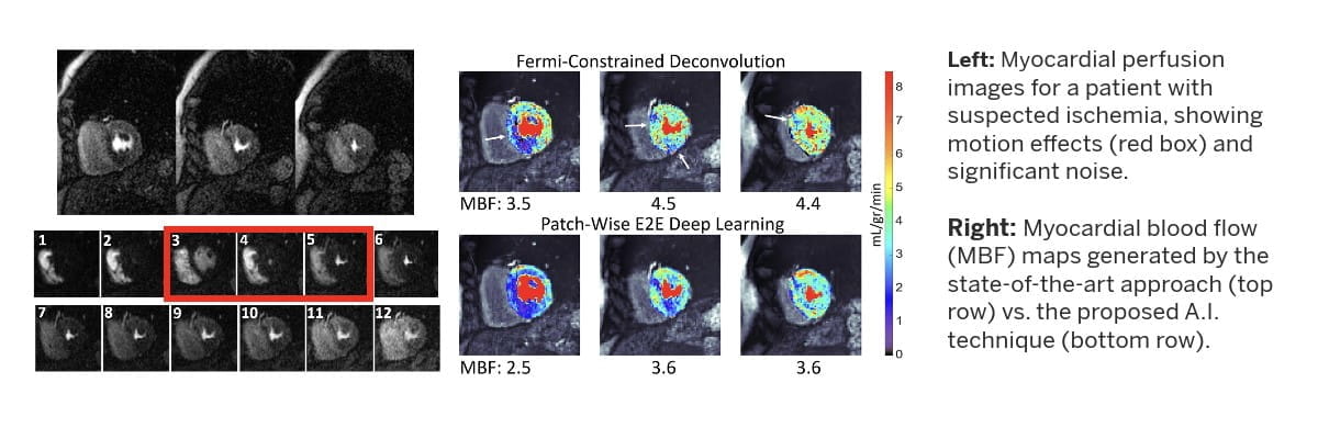 on the left are myocardial perfusion images for a patient with suspected ischemia, showing motion effects and significant noise. On the right are myocardial blood flow maps generated by the state-of-the-art approach vs. the proposed AI technique