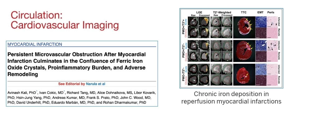 graphic from this publication shows chronic iron deposition in reperfusion myocardial infarctions