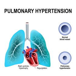 Illustration of pulmonary hypertension with normal blood vessel comparison, with both heart and lungs displayed.