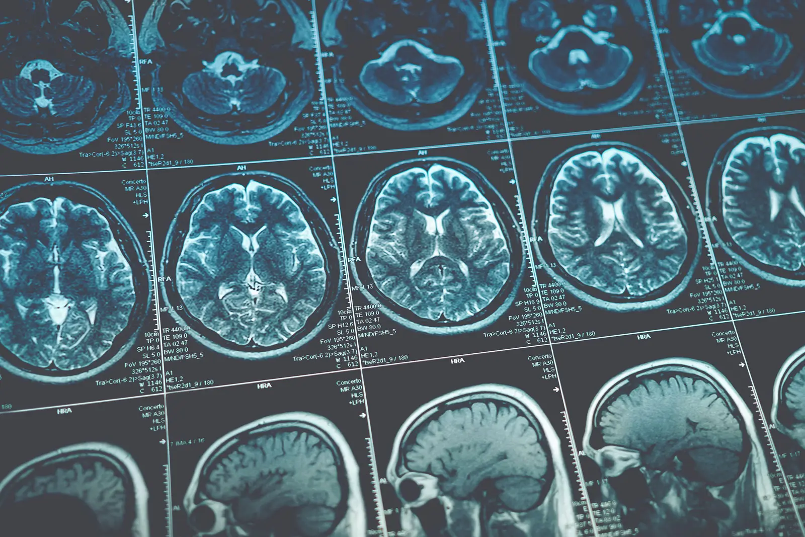 Brain imaging