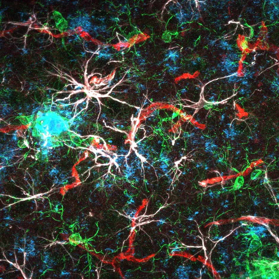 A fluorescent confocal microscopy 63x image of the cortex from an 18-month-old humanized amyloid mouse model 