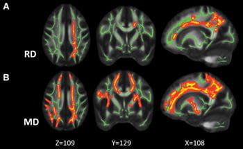MRI image