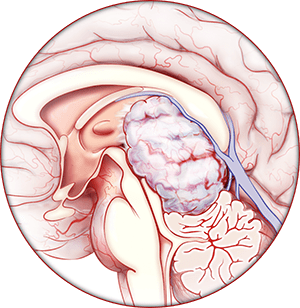Neuro-Oncology Illustration