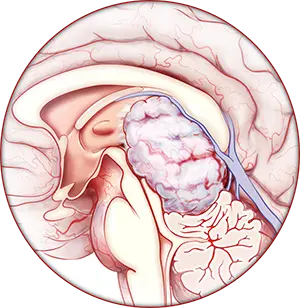 Neuro-Oncology Illustration