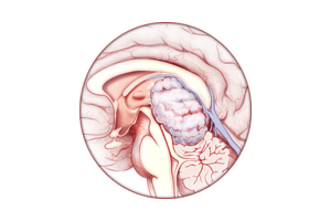 neuro-oncology center