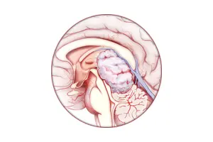 neuro-oncology center
