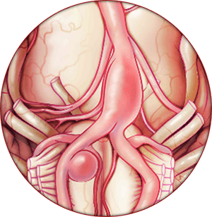 Neurovascular Disorder Illustration