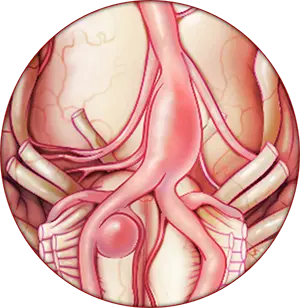 Neurovascular Disorder Illustration