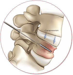 Spinal Disorder Illustration