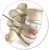 Spinal Disorder Illustration