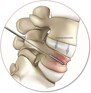 Spinal Disorder Illustration