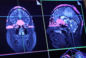 Head and brain scan in two views
