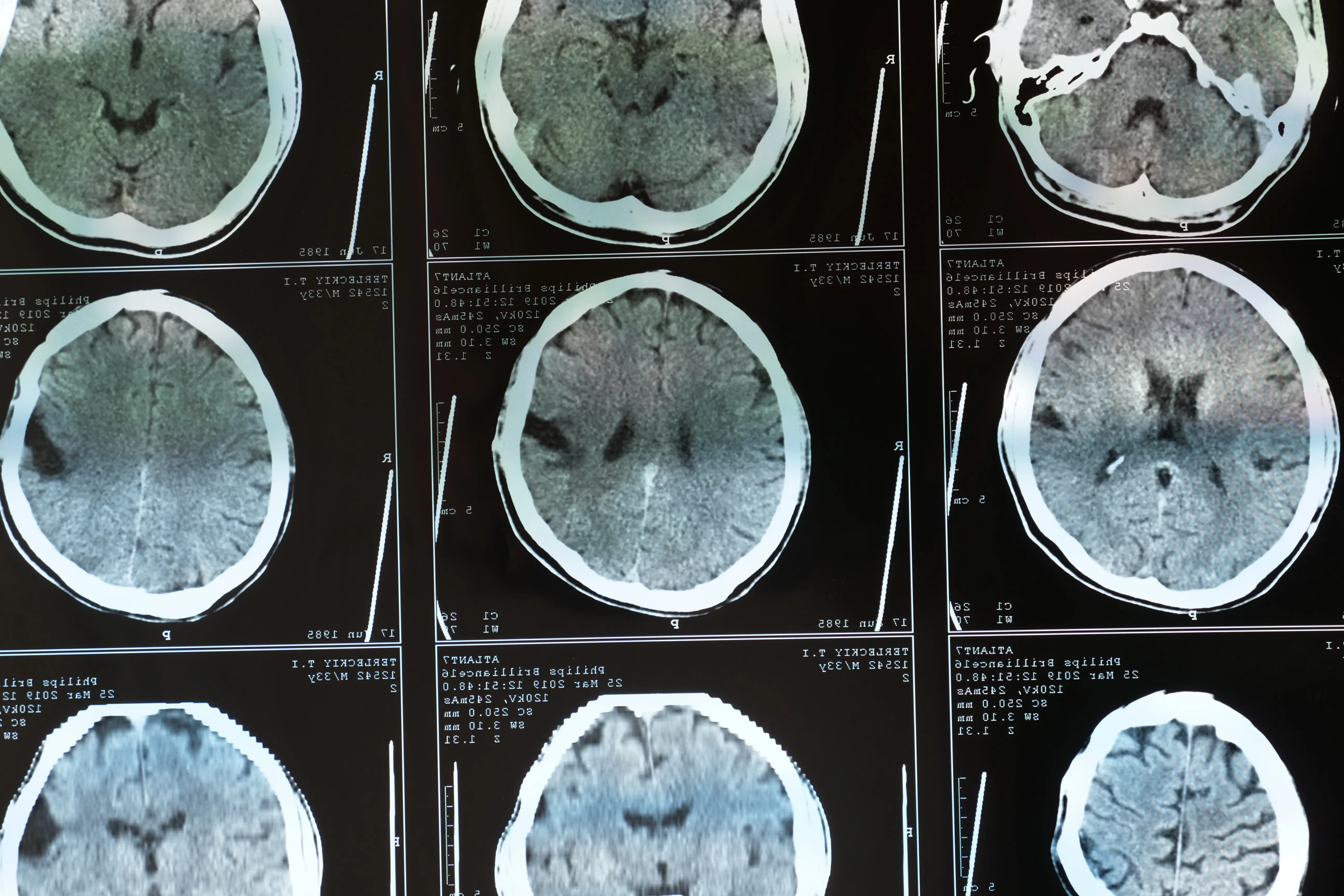 an MRI image of TBI