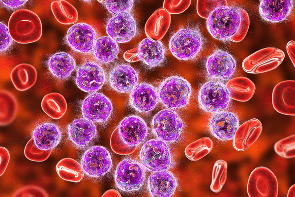 acute leukemia cells