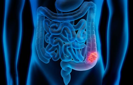 An illustration of a blockage in a digestive tract.