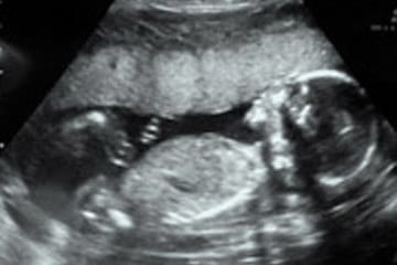 sonogram