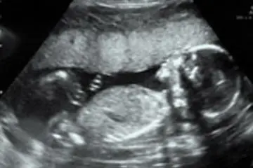 sonogram