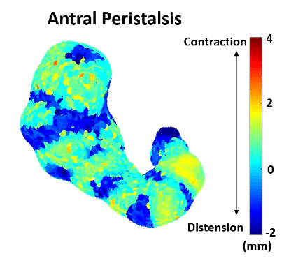Image featuring Antral Peristalsis