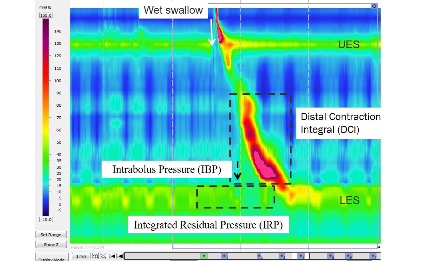 Esophageal impedance manometry