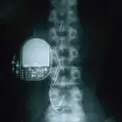 Gastric Electrical Stimulation Program