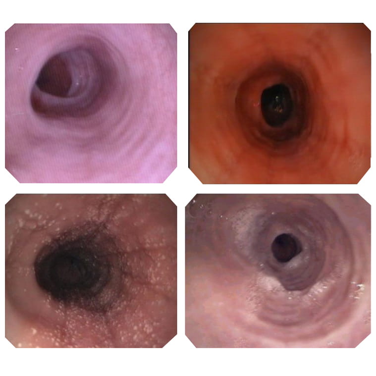 Photos of Eosinophilic Esophagitis showing circumferential rings, edema, exudate and strictures
