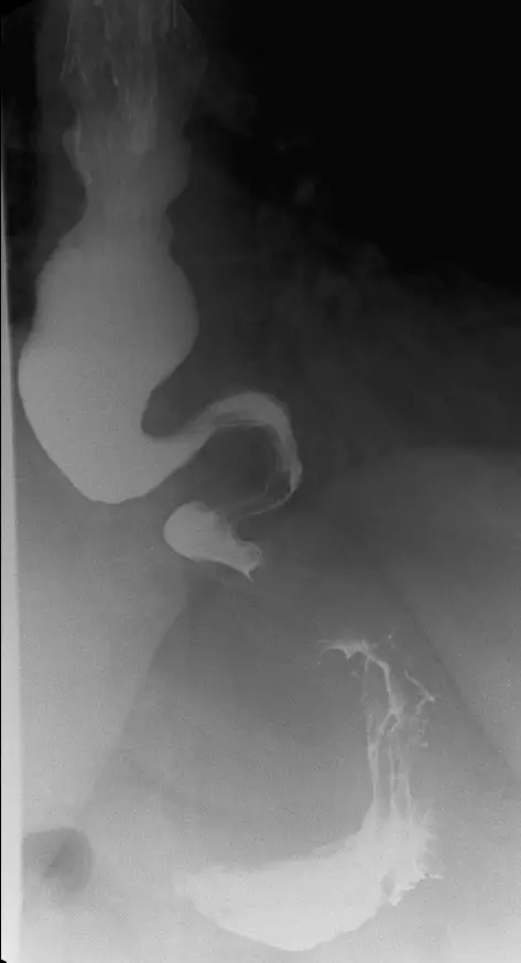 POEM for Achalasia