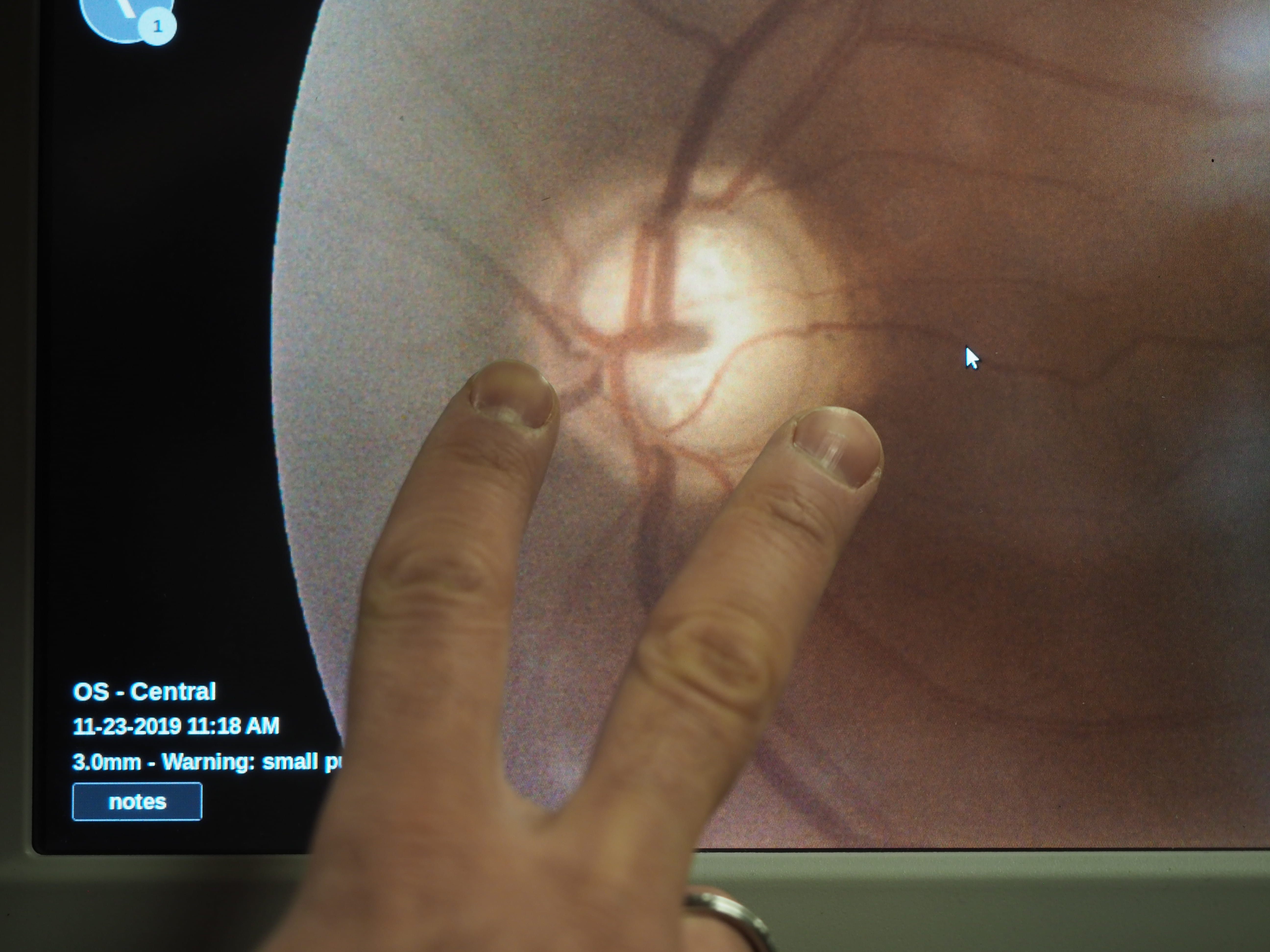A scan of a patient’s eye is displayed on a computer screen.