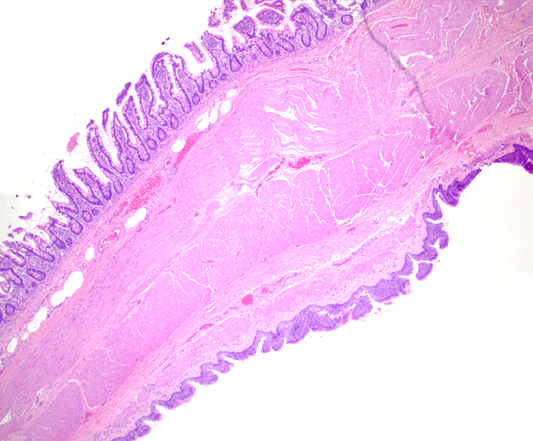 histology slide of cyst on instestinal wall