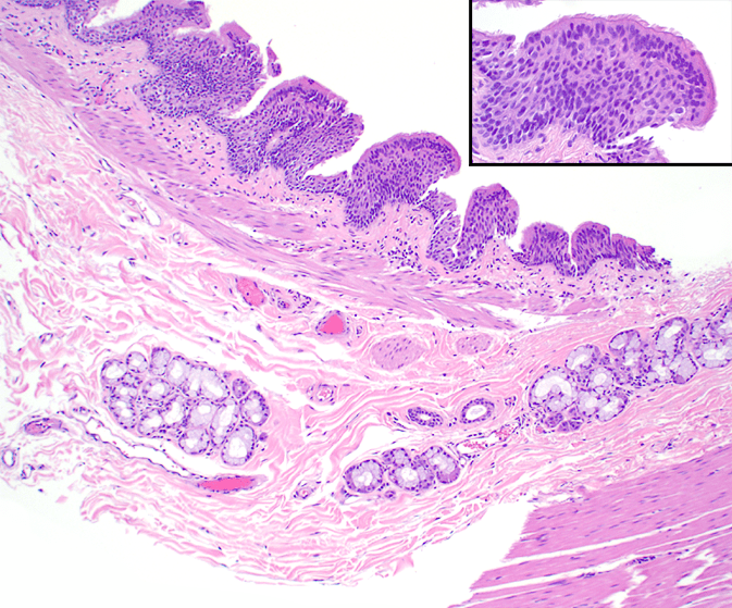 closer histology slide of the cyst