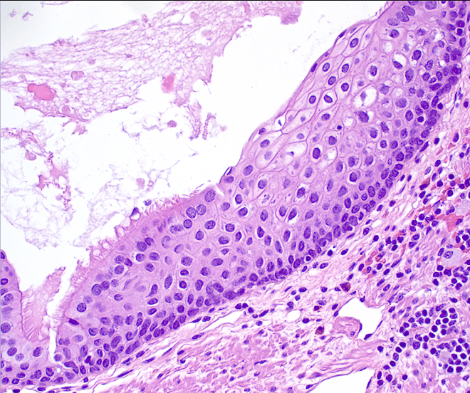 cyst lining histology slide
