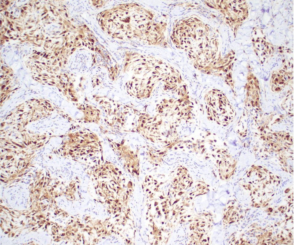 Case of the Month, October 2025, Figure 3. Microscopic image