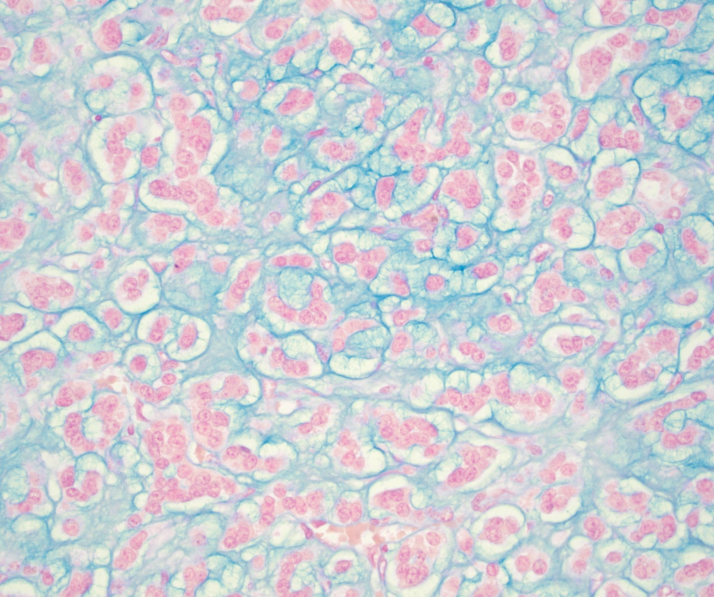 immunohistochemistry sample with pink and teal cells