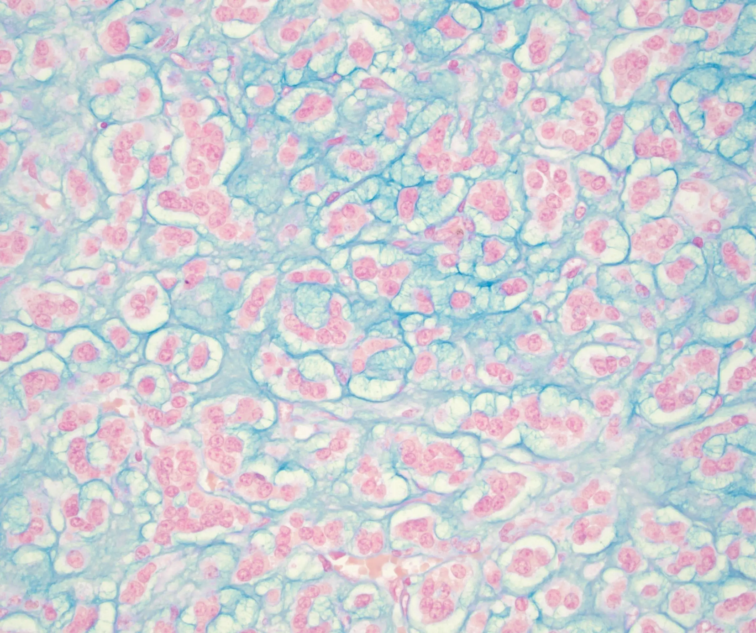 immunohistochemistry sample with pink and teal cells