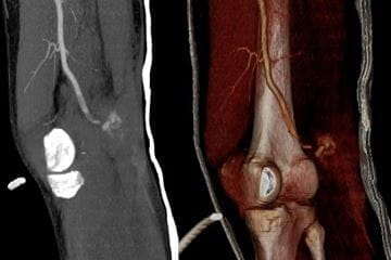 MRI scan of Joint