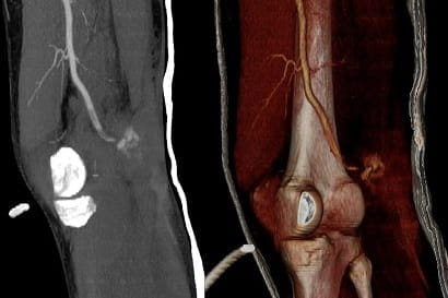 MRI scan of Joint
