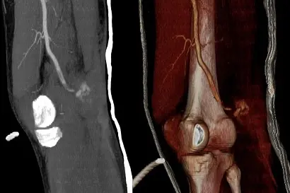 MRI scan of Joint