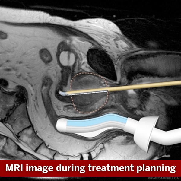 MRI imaging