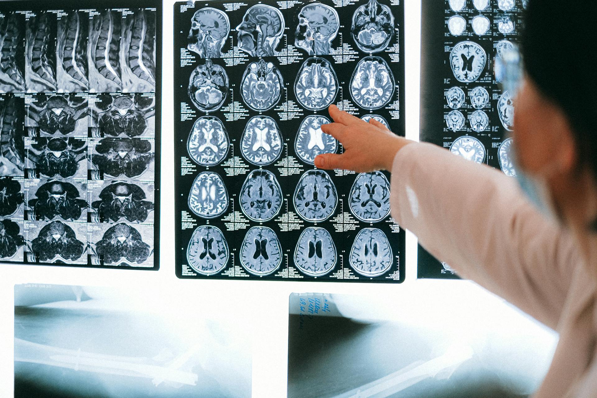 A physician points to a neuro scan.